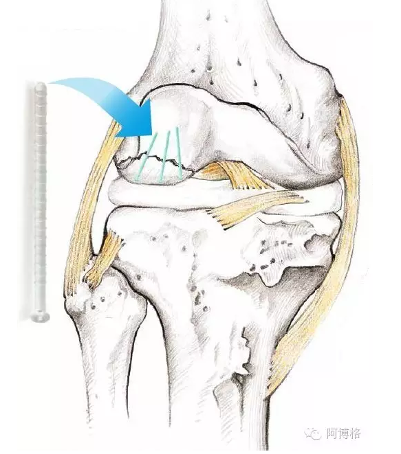 注塑膝盖骨钉之后 是增材制造特性化头骨吗？