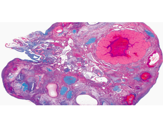 3D打印自然卵巢开启生殖医学新纪元