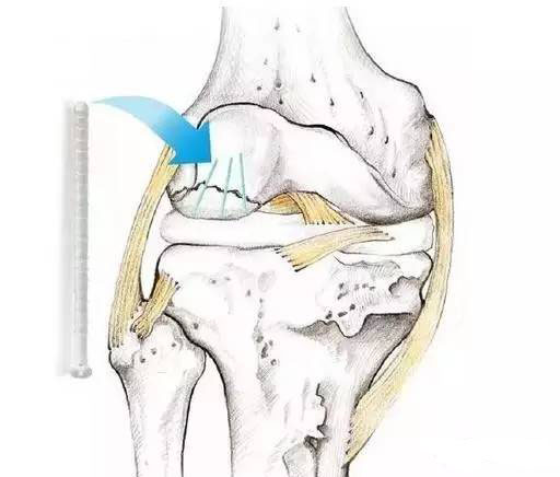 阿博格：成功研发以PLA为根底资料的医疗注塑技术
