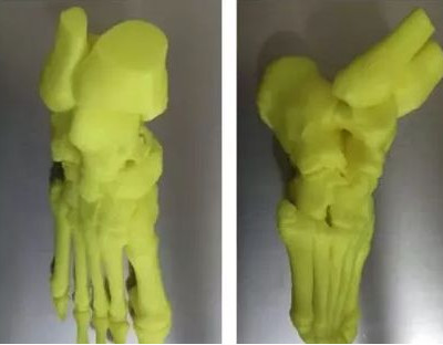 3D打印技术运用于骨科手术