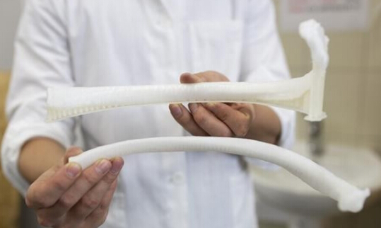 3D打印肋骨植入人体