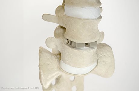 赢创VESTAKEEP® 聚醚醚酮到达FDA审批数量里程碑